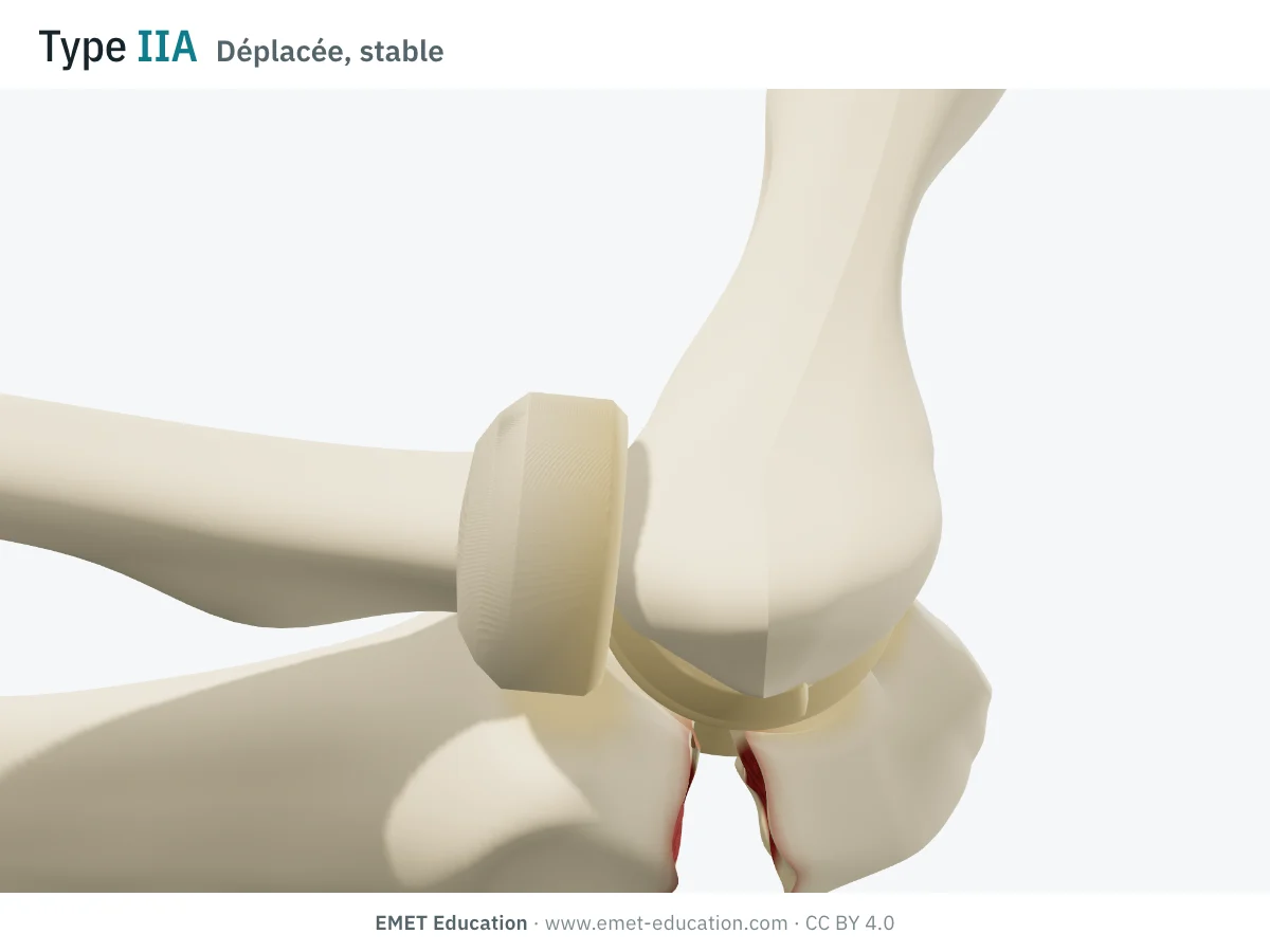 Coude en 3D vu de profil, type IIA de Mayo : fragment olécrânien basculé et remonté, foyer ouvert en arrière, articulation en place.