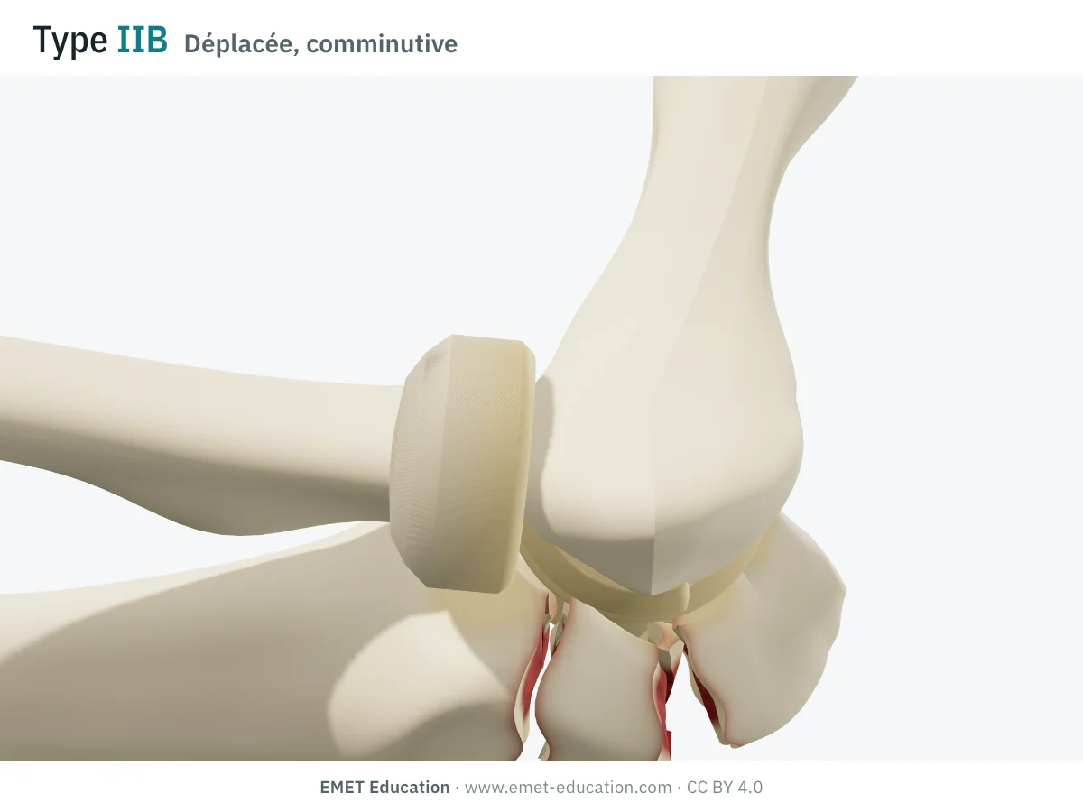 Coude en 3D vu de profil, type IIB de Mayo : olécrâne éclaté en plusieurs fragments, fragment proximal remonté, articulation en place.