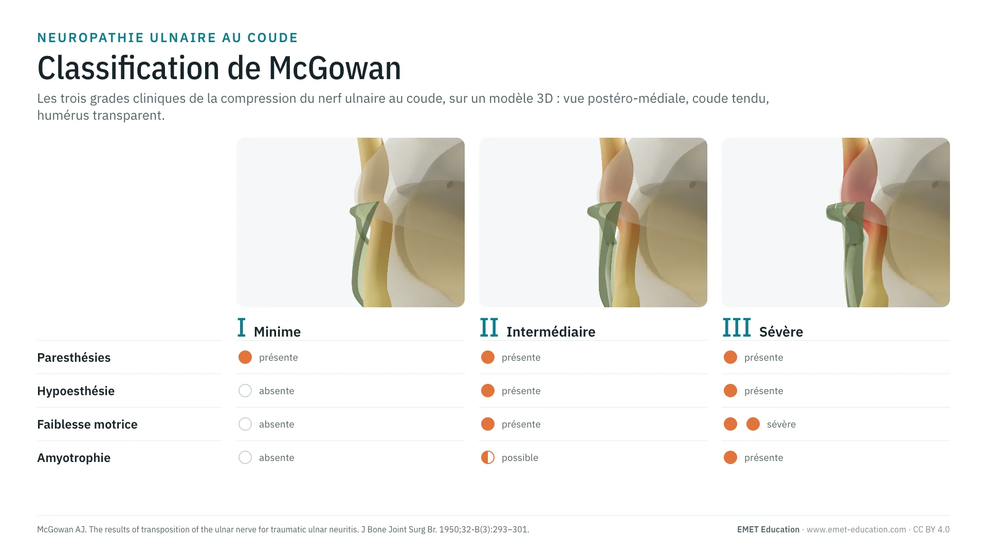 Infographie : les grades I à III de McGowan, le nerf ulnaire sous la bande d'Osborne en 3D (de plus en plus gonflé et rouge au-dessus d'elle), et un tableau des signes cliniques par grade : paresthésies, hypoesthésie, faiblesse motrice, amyotrophie.