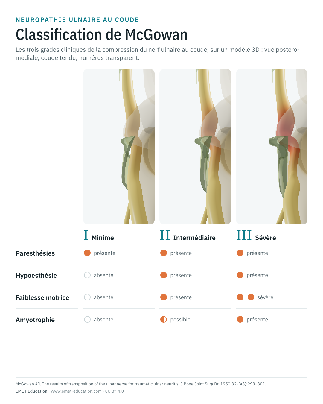 Infographie en portrait de la classification de McGowan : le nerf aux trois grades, puis le tableau des signes cliniques.