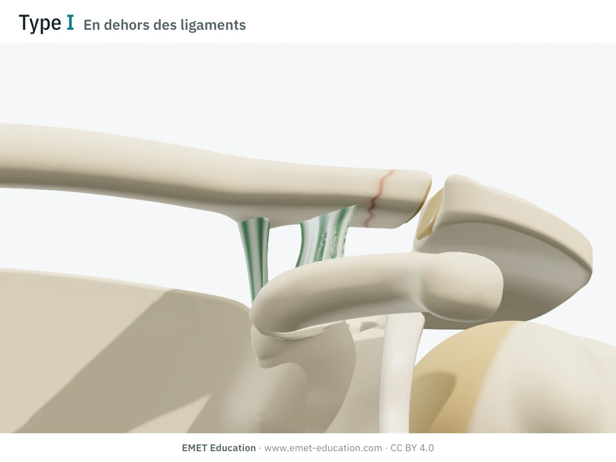 Épaule en 3D vue de face, type I de Neer : trait fin sur le bout latéral de la clavicule, en dehors des ligaments, sans déplacement.