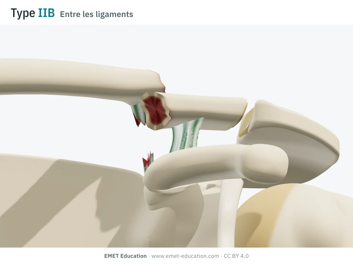 Épaule en 3D vue de face, type IIB de Neer : trait entre les deux ligaments, conoïde rompu, fragment médial monté.