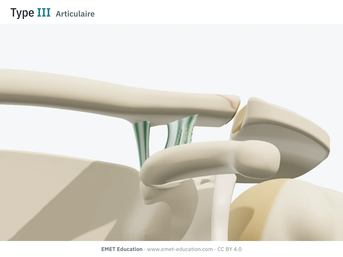 Épaule en 3D vue de face, type III de Neer : trait discret du bout latéral de la clavicule jusqu'à l'articulation acromio-claviculaire.