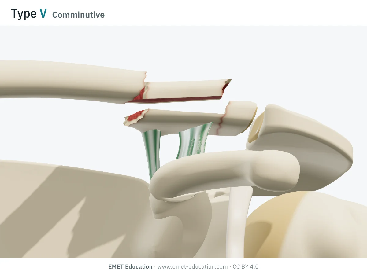 Épaule en 3D vue de face, type V de Neer : fracture comminutive, un fragment inférieur garde les ligaments, le fragment médial monte.