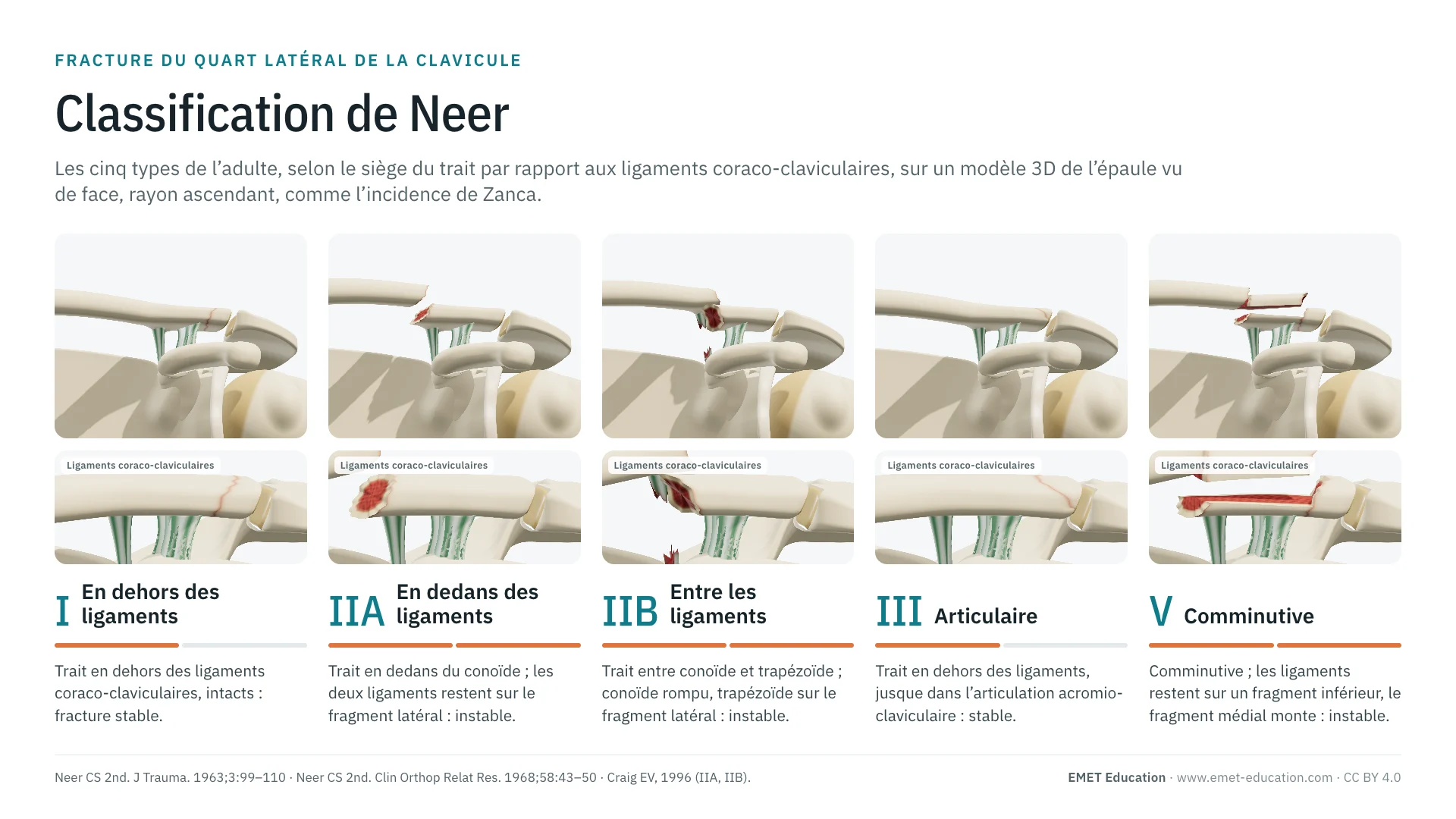 Infographie : les cinq types de Neer de l'adulte sur une épaule en 3D vue de face, rayon ascendant, de la fracture en dehors des ligaments (I) à la fracture comminutive (V), avec un zoom des ligaments coraco-claviculaires sous chaque type.