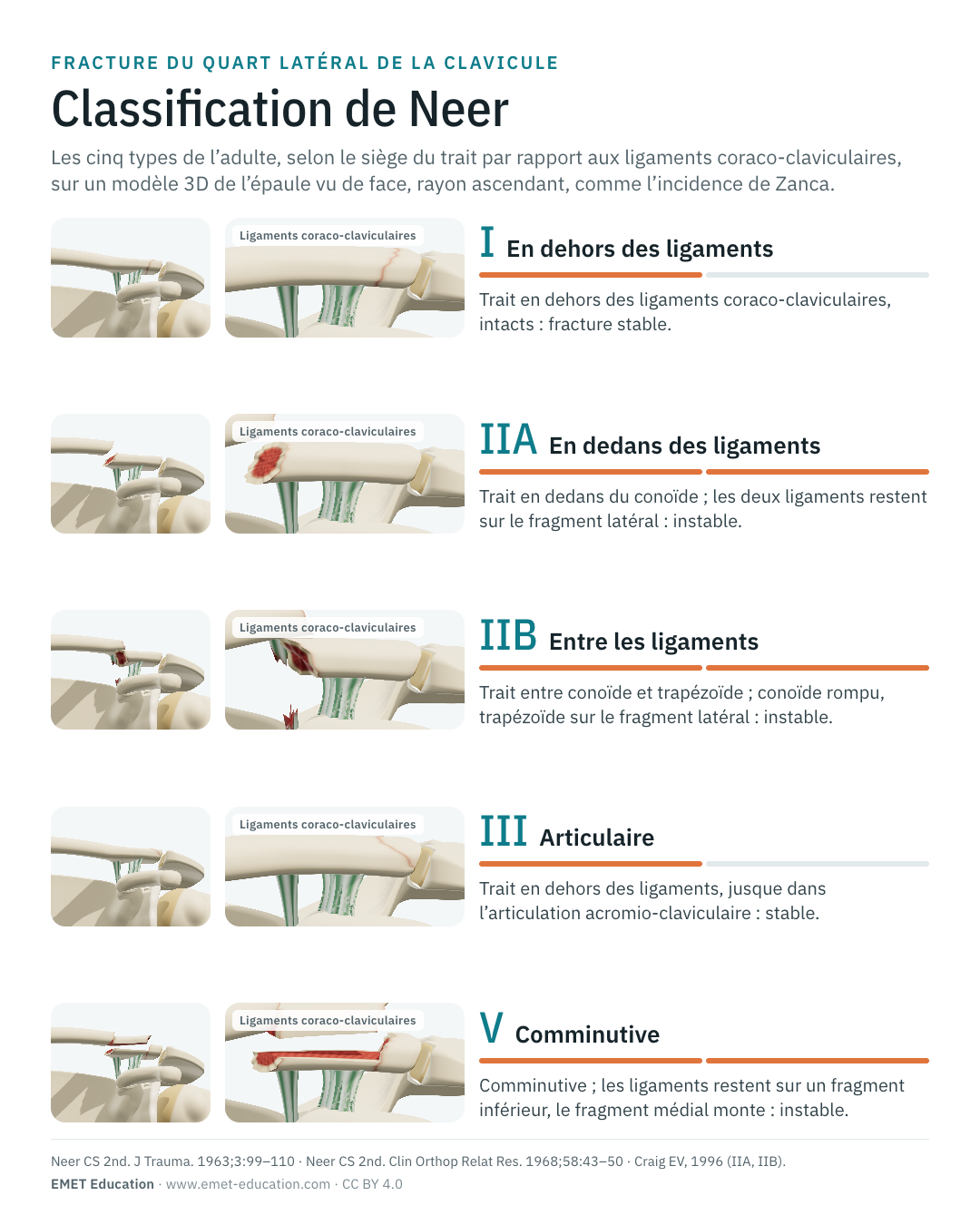 Infographie en portrait des cinq types de Neer de l'adulte, une ligne par type.