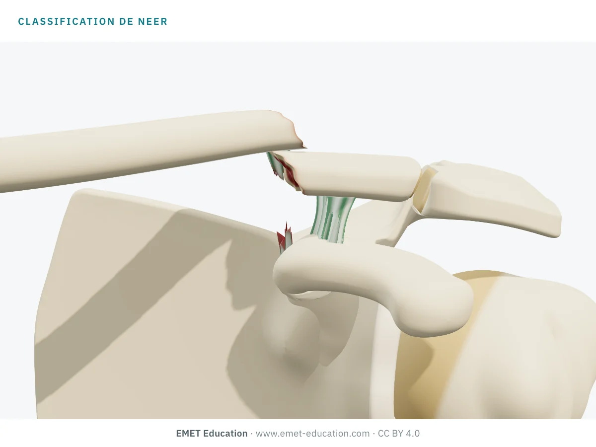 Épaule en 3D vue de face, à un type de Neer inconnu, pour l'autoévaluation.
