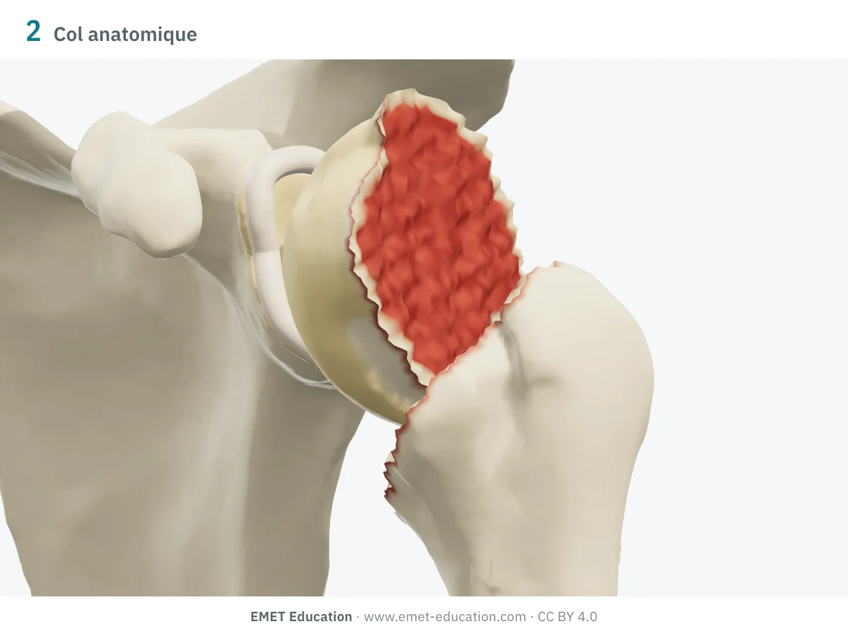 Épaule gauche en 3D vue de face, fracture à 2 parties du col anatomique : la tête basculée en varus, sa tranche visible.