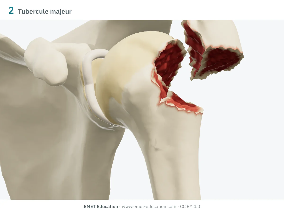 Épaule gauche en 3D vue de face, fracture à 2 parties du tubercule majeur : le fragment tiré en haut, sous l'acromion.