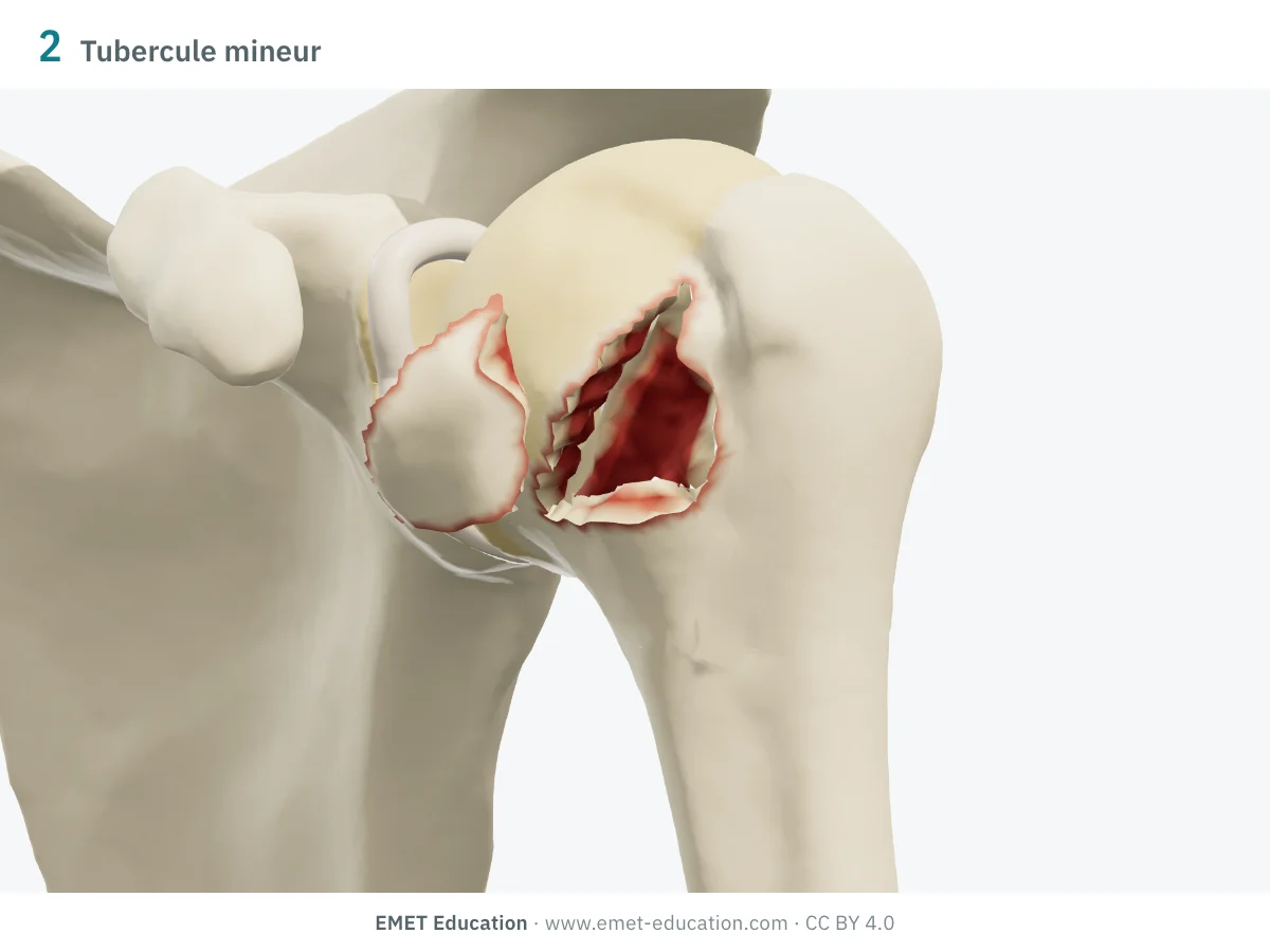 Épaule gauche en 3D vue de face, fracture à 2 parties du tubercule mineur : le fragment écarté en dedans, devant la tête.