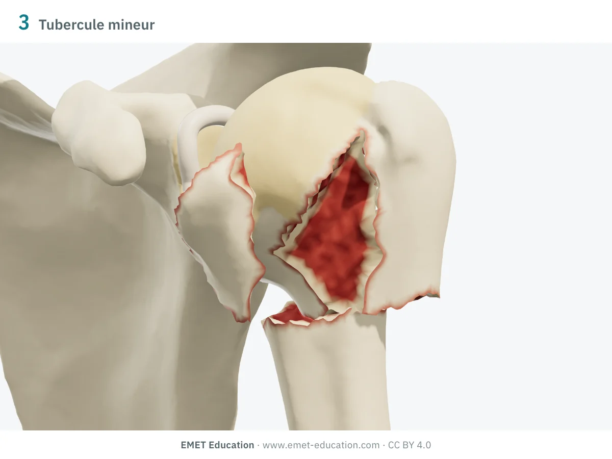 Épaule gauche en 3D vue de face, fracture à 3 parties : col chirurgical et tubercule mineur déplacés.