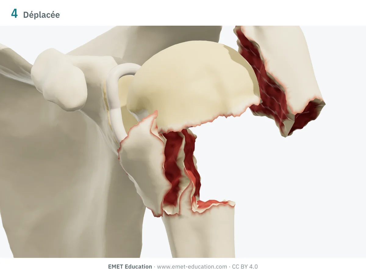 Épaule gauche en 3D vue de face, fracture à 4 parties : tête en valgus, tubercules séparés, diaphyse translatée.