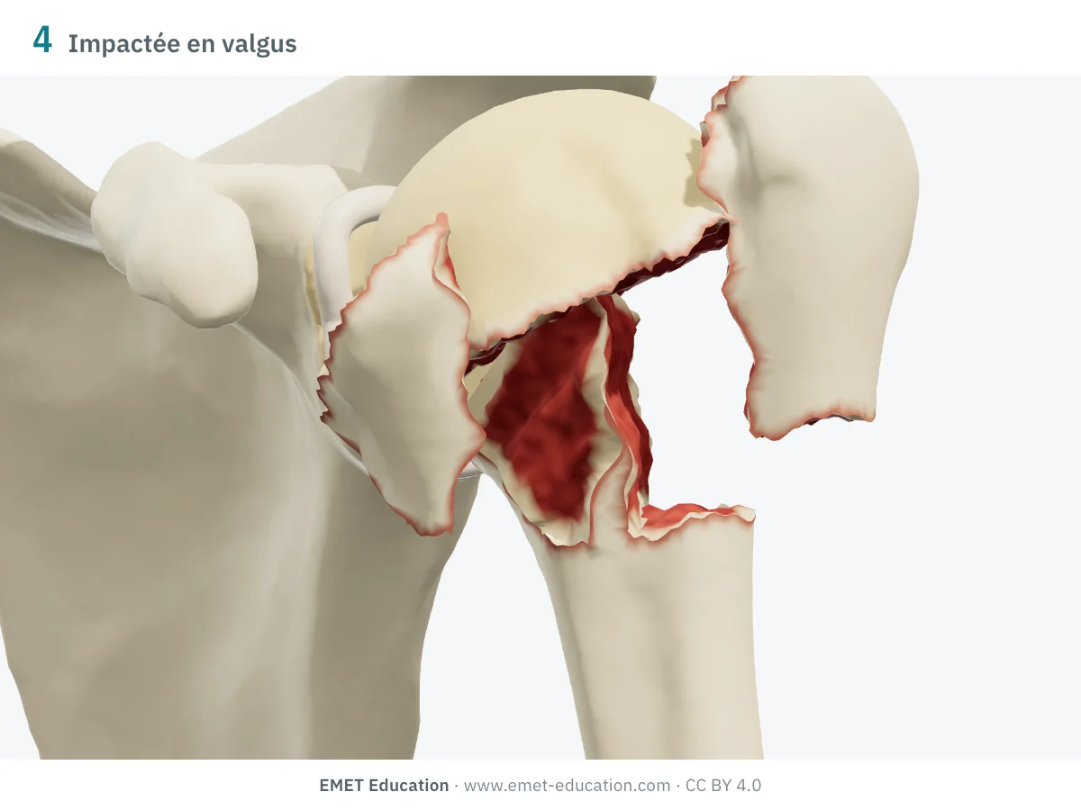 Épaule gauche en 3D vue de face, fracture à 4 parties impactée en valgus : tête enfoncée entre les tubercules écartés.