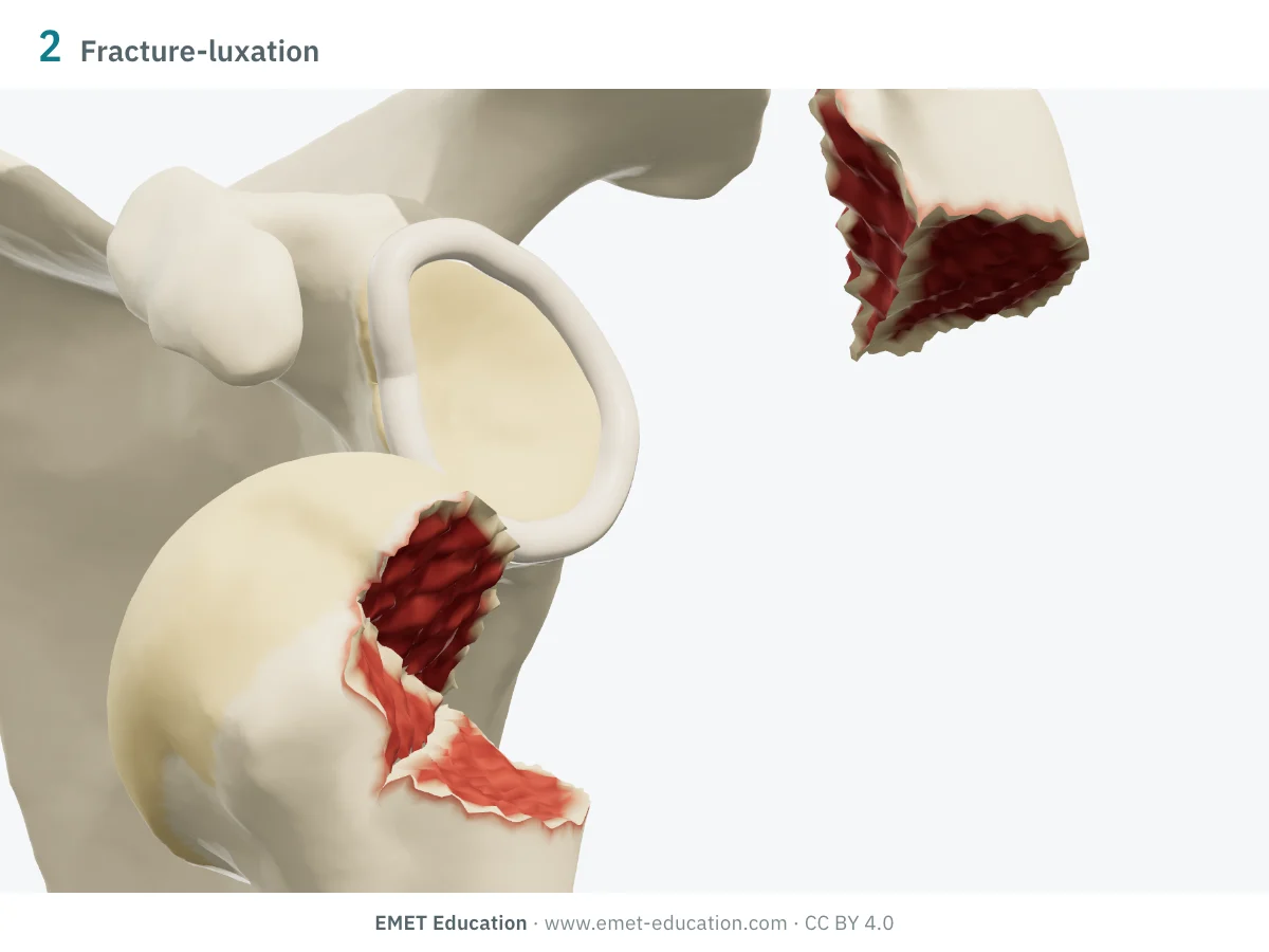 Épaule gauche en 3D vue de face, fracture-luxation antérieure : tête sortie en avant de la glène, tubercule majeur resté en haut.