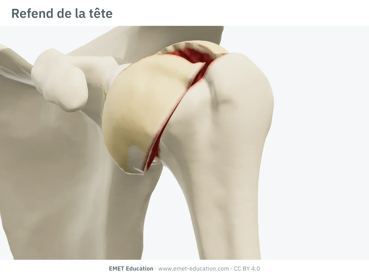 Épaule gauche en 3D vue de face, refend de la tête : un fragment antérieur de la surface articulaire ouvert en avant.