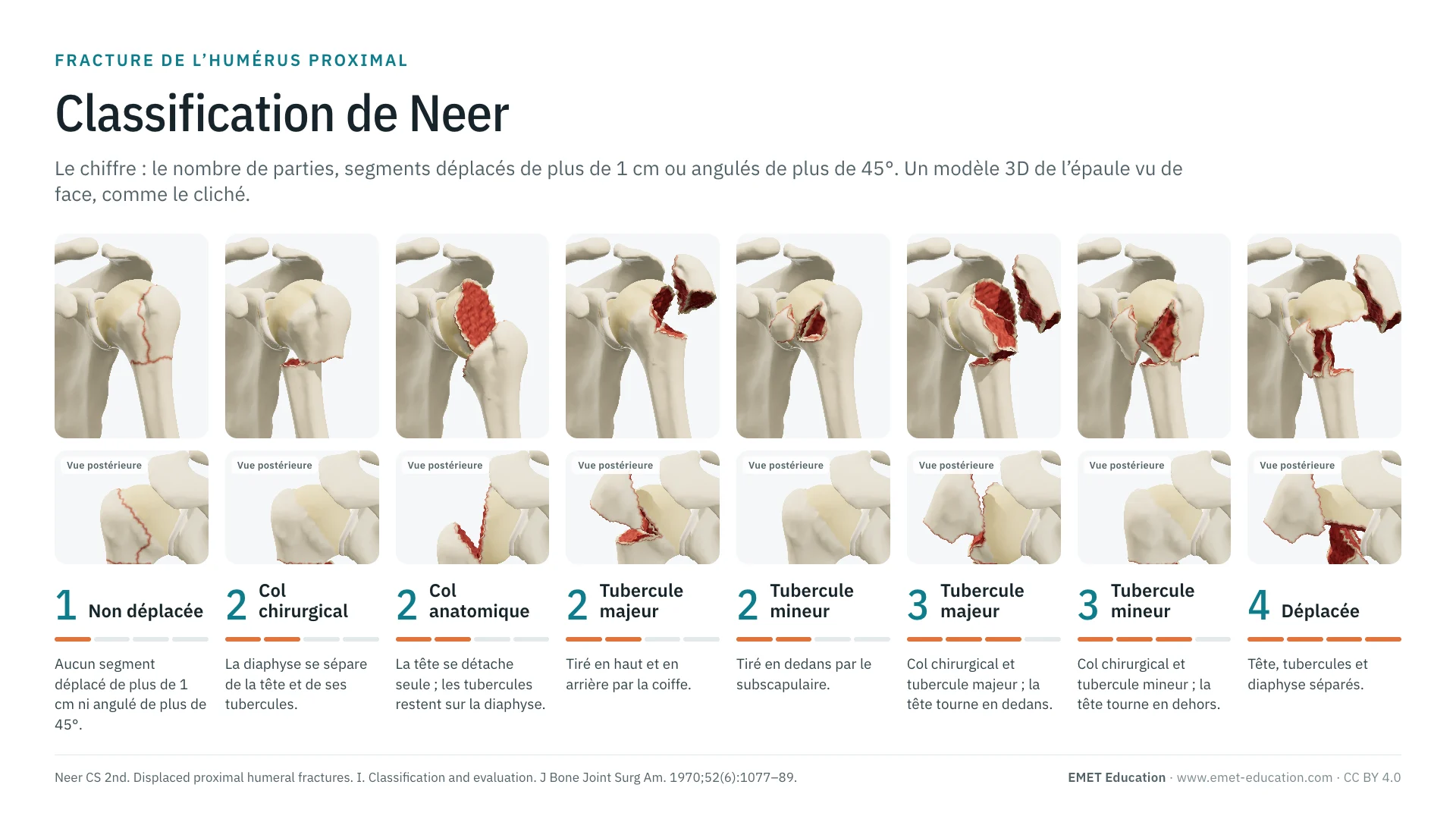 Infographie : les catégories de Neer de 1 à 4 parties sur une épaule en 3D vue de face, de la fracture non déplacée à la fracture à 4 parties, avec une vue postérieure sous chaque catégorie.