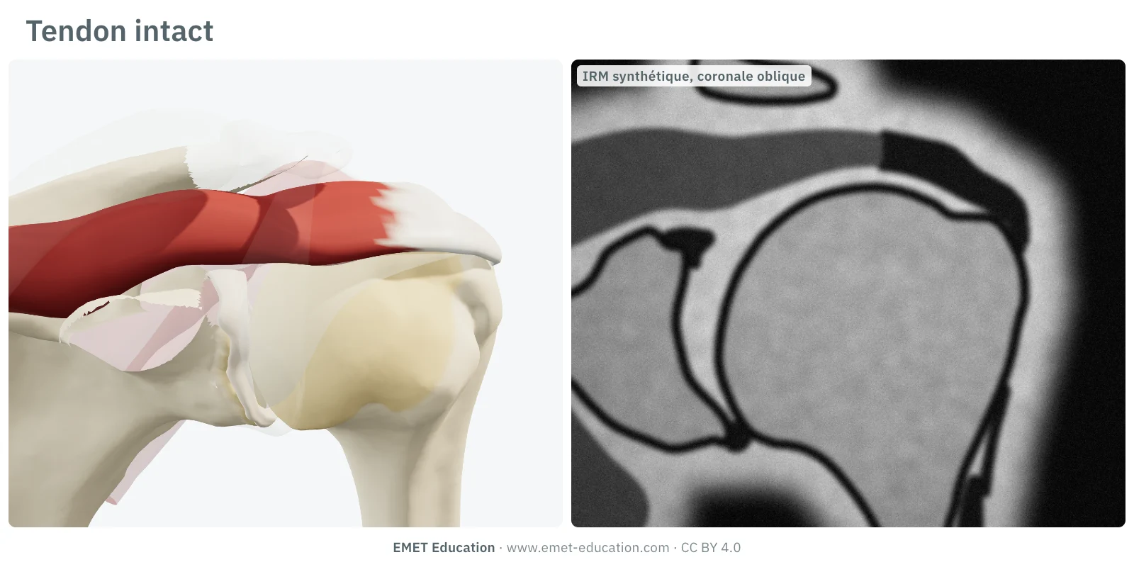 Épaule en 3D vue dans le plan de la scapula et coupe IRM coronale oblique synthétique : le supra-épineux intact recouvre la tête et s'insère sur le tubercule majeur.