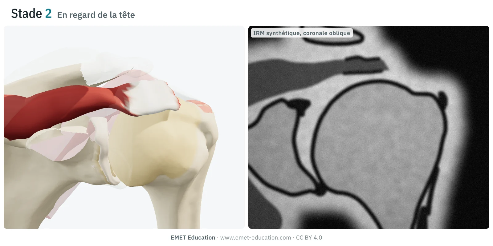 Épaule en 3D et coupe IRM synthétique, stade 2 de Patte : le moignon du supra-épineux se trouve au-dessus de la tête humérale, l'empreinte est découverte.