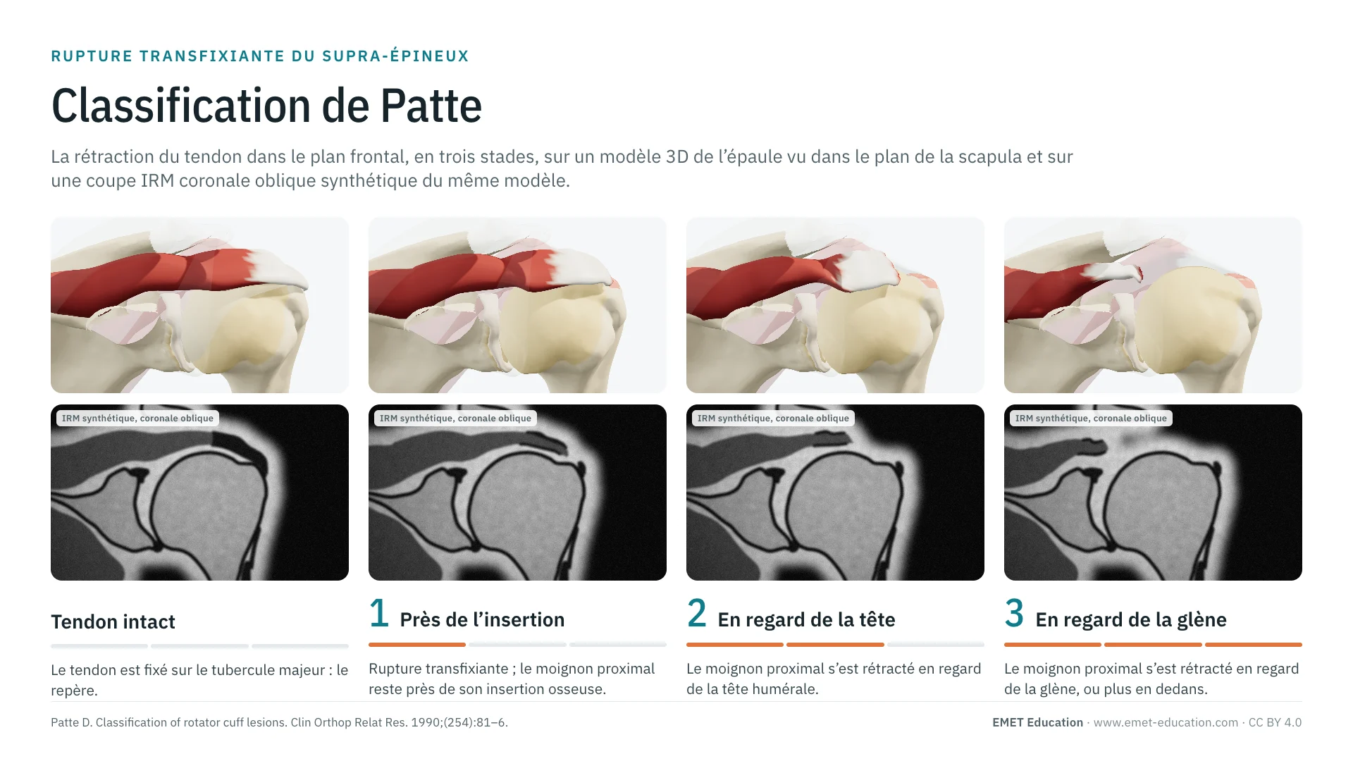 Infographie : la classification de Patte sur une épaule en 3D vue dans le plan de la scapula, du tendon intact au stade 3, avec sous chaque image la coupe IRM coronale oblique synthétique correspondante.