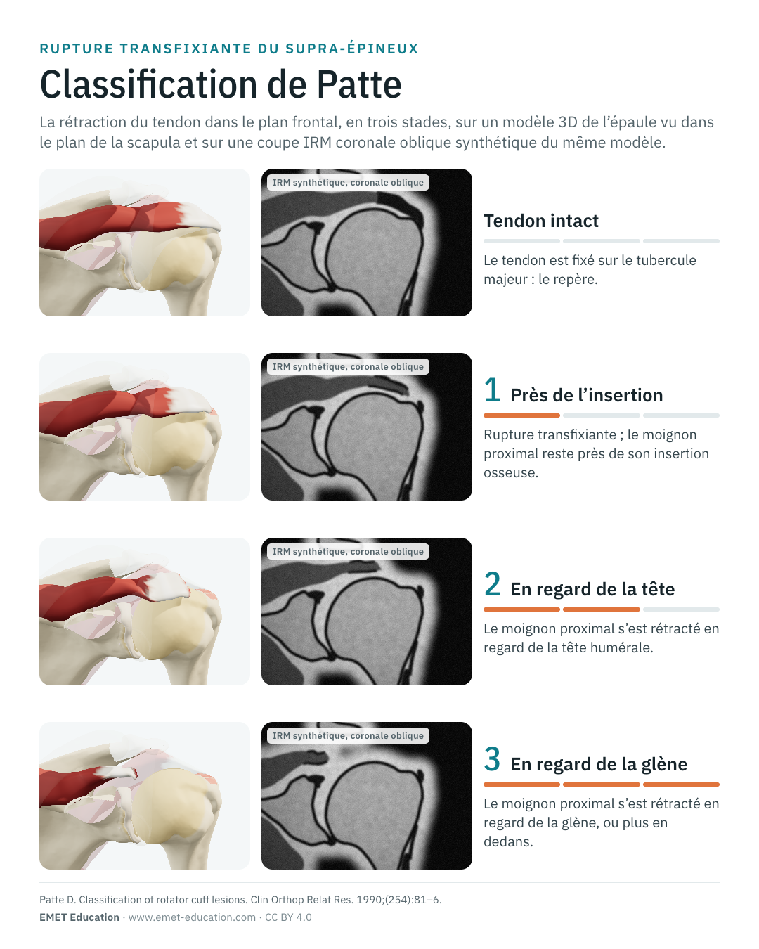Infographie en portrait de la classification de Patte, une ligne par stade, la 3D et la coupe IRM côte à côte.