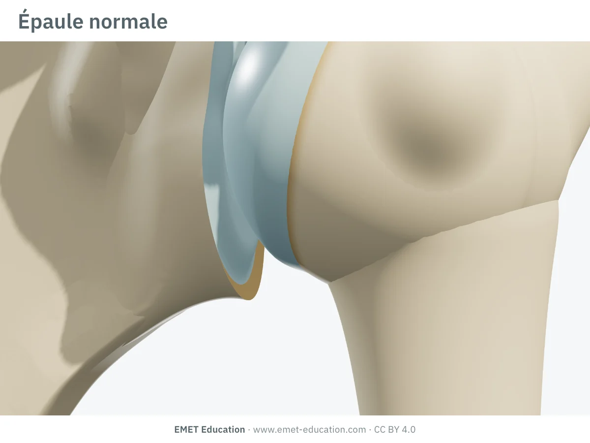Épaule en 3D vue de face, normale : cartilage intact, contours inférieurs de la tête humérale et de la glène sans ostéophyte.