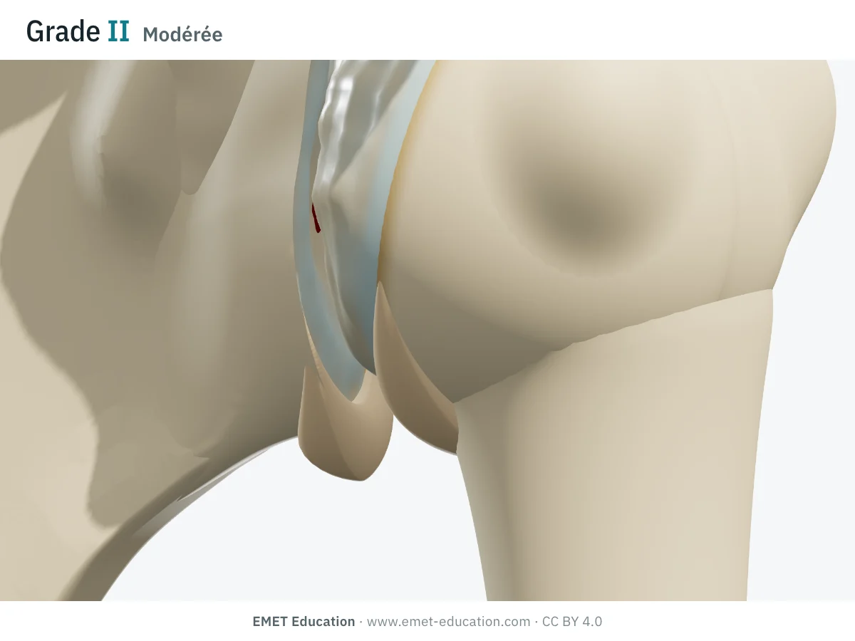 Épaule en 3D vue de face, grade II de Samilson et Prieto : ostéophytes nets sous la tête et la glène, cartilage usé par plages.