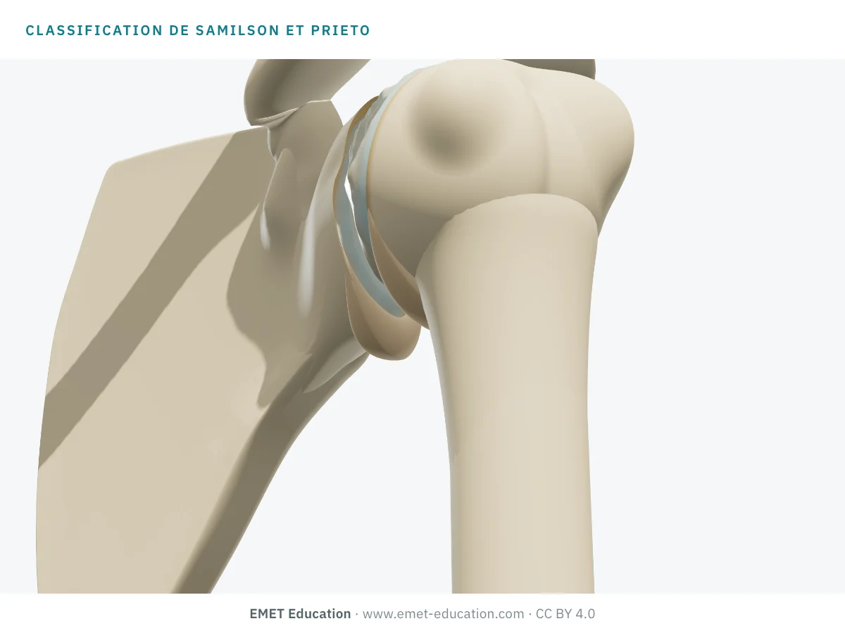 Épaule en 3D vue d'en avant et d'en bas, à un grade de Samilson et Prieto inconnu, pour l'autoévaluation.