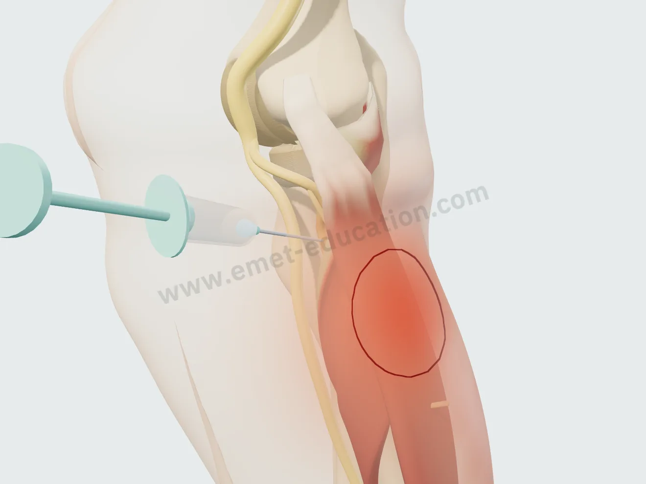 Hydrodissection, étape 1 : l'aiguille en place au contact du nerf, avant-bras en supination.
