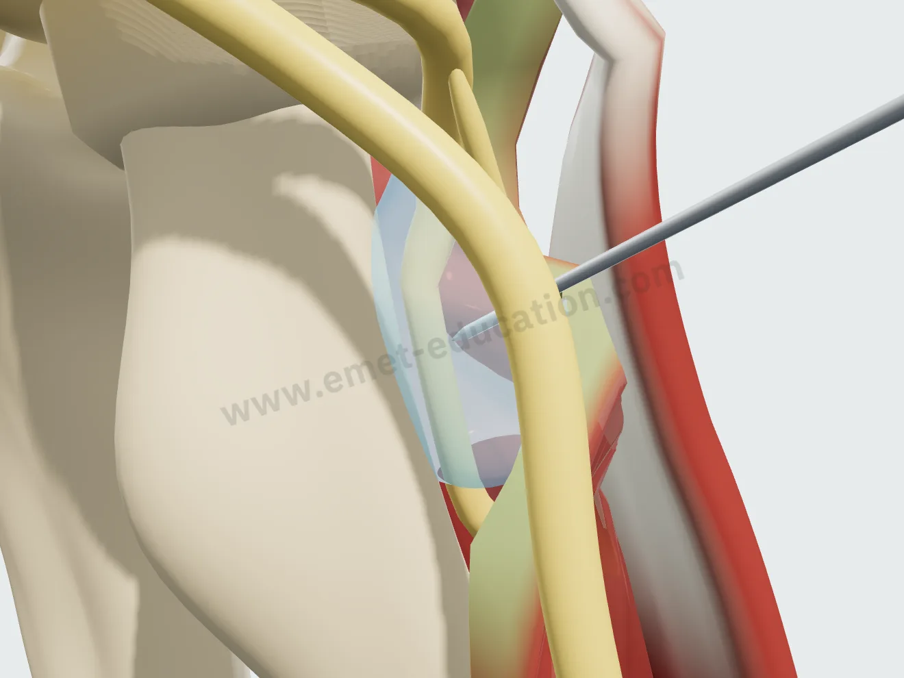 Hydrodissection, étape 2 : le liquide glissé sous l'arcade de Fröhse, qui s'écarte du nerf.