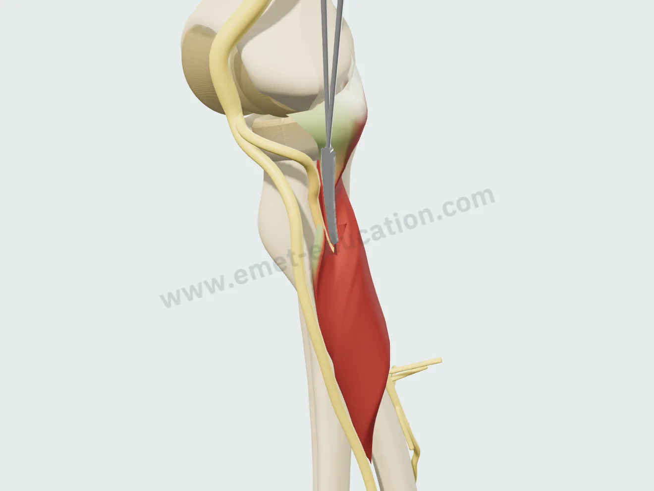 Neurolyse, étape 2 : la fente poursuivie dans le supinateur sur 1 cm, le nerf à nu.