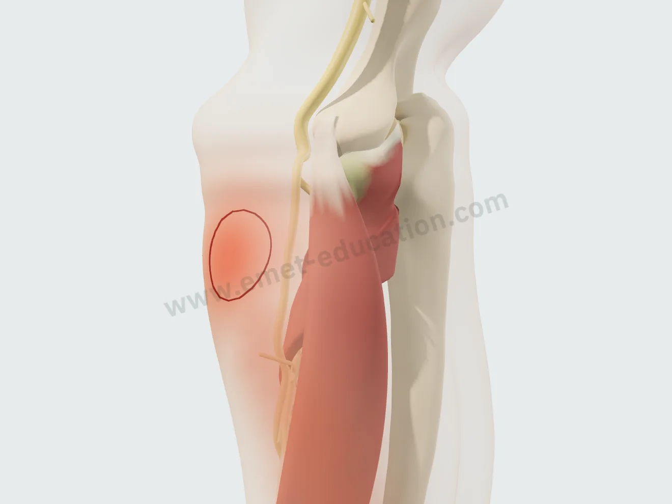 Compression du nerf interosseux postérieur : sous la peau translucide, une zone douloureuse profonde sur le haut de l'avant-bras, avec son irradiation.