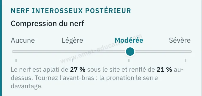 Panneau du modèle : glissière de la compression du nerf interosseux postérieur, au cran « Modérée », avec la mesure lue dessous.
