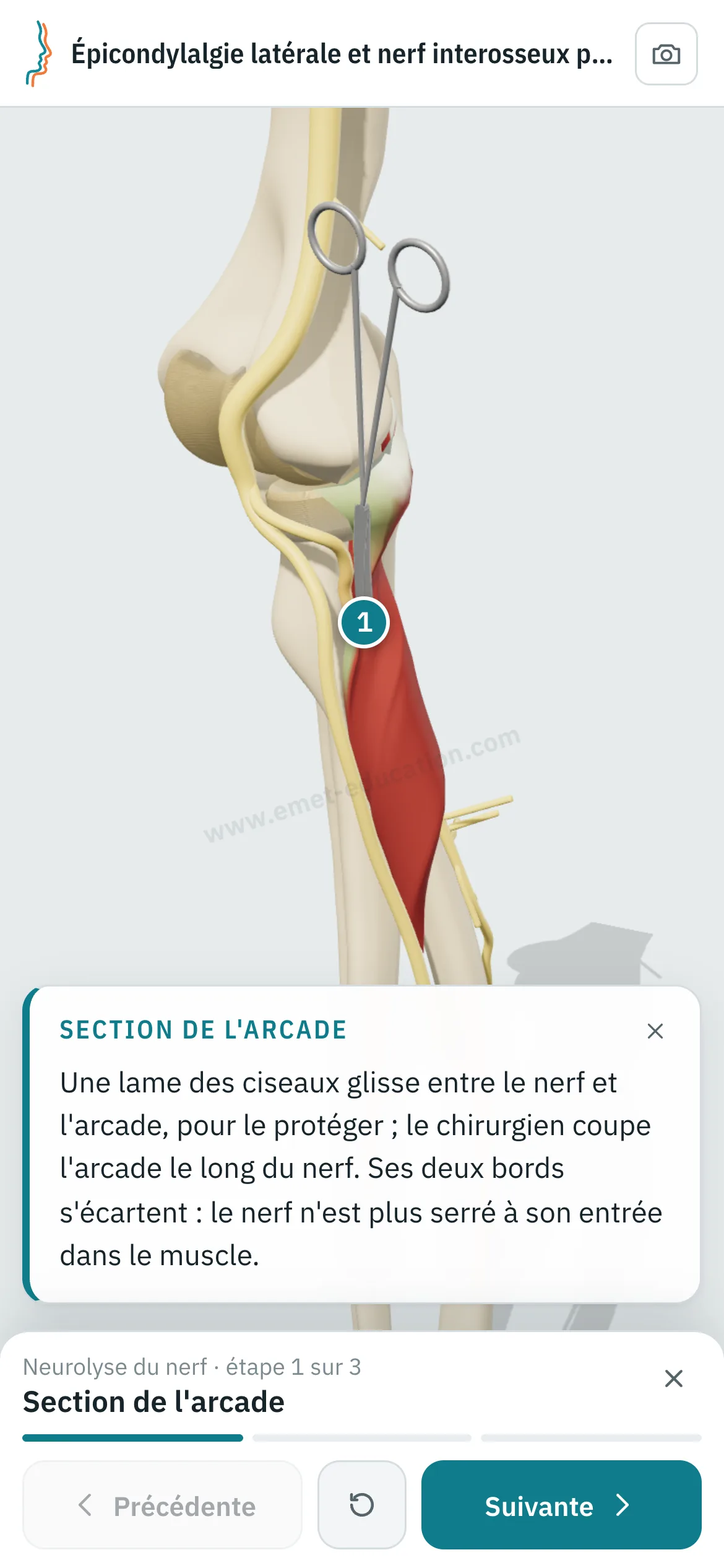 Vue patient sur un téléphone : la neurolyse du nerf interosseux postérieur rejouée étape par étape.