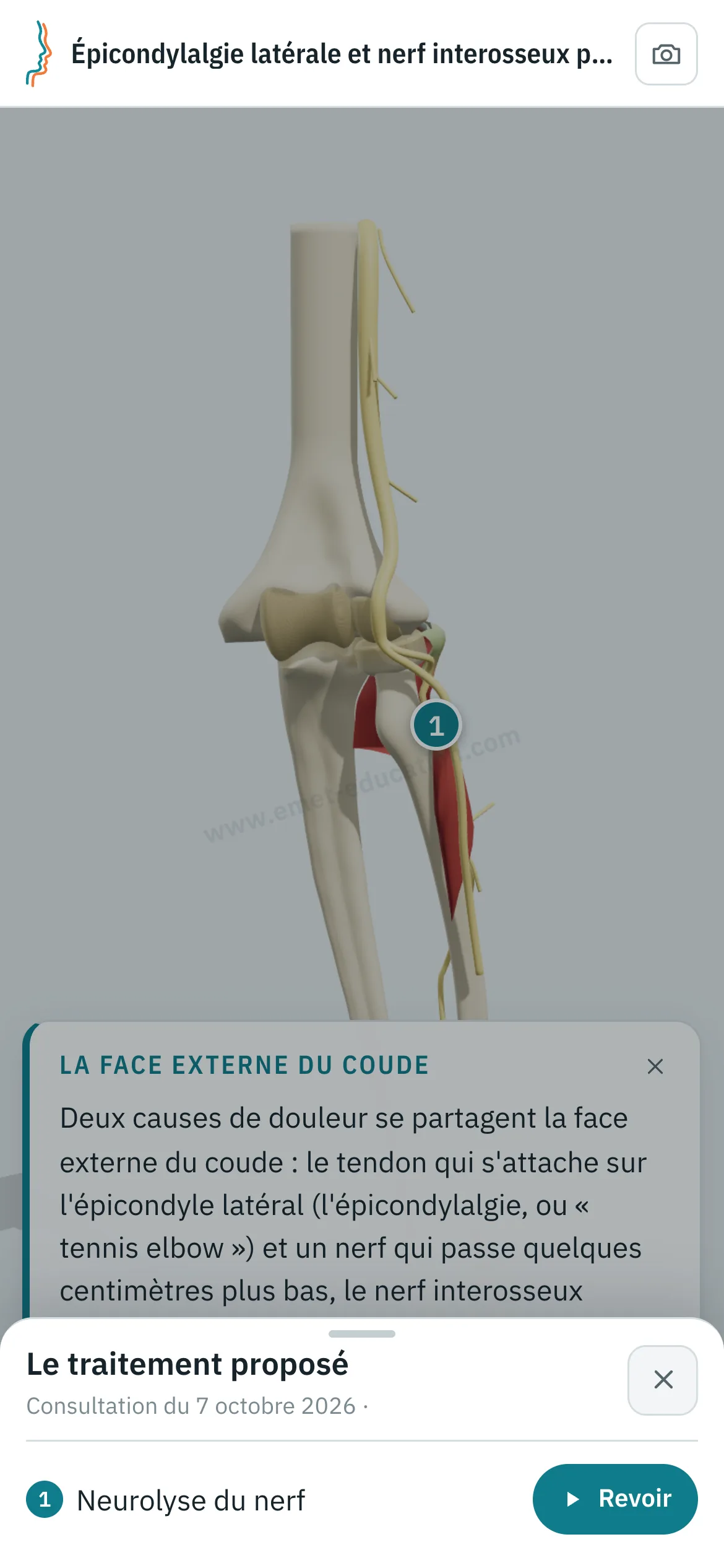 Vue patient sur un téléphone : le coude après neurolyse du nerf interosseux postérieur, et le volet « Le traitement proposé » ouvert, avec le bouton « Revoir ».