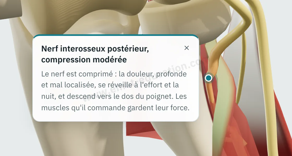 Bulle d'explication « Arcade de Fröhse » affichée après un toucher sur l'arcade, au-dessus du nerf comprimé.