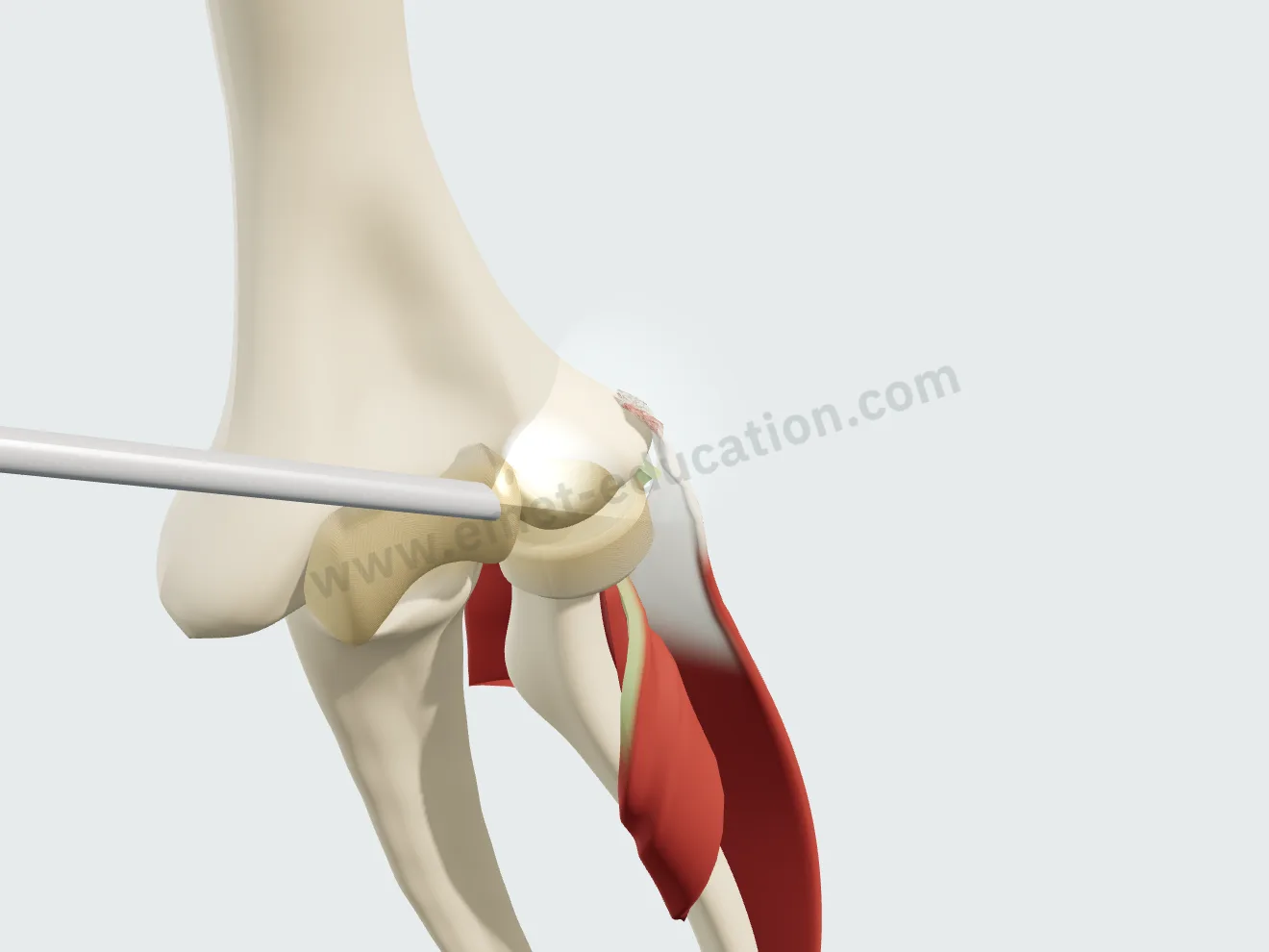 Arthroscopie, étape 1 : l'arthroscope à 30° en place, sa lumière froide éclairant l'enthèse malade.