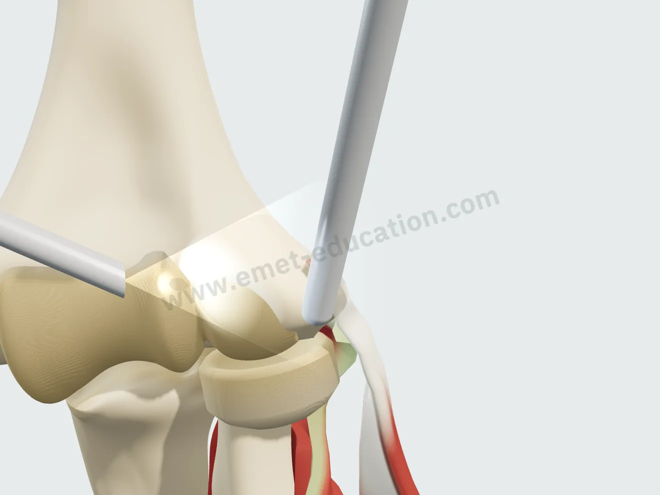 Arthroscopie : la caméra et le shaver sont introduits dans le coude ; la fenêtre du shaver est posée contre la face profonde du tendon.