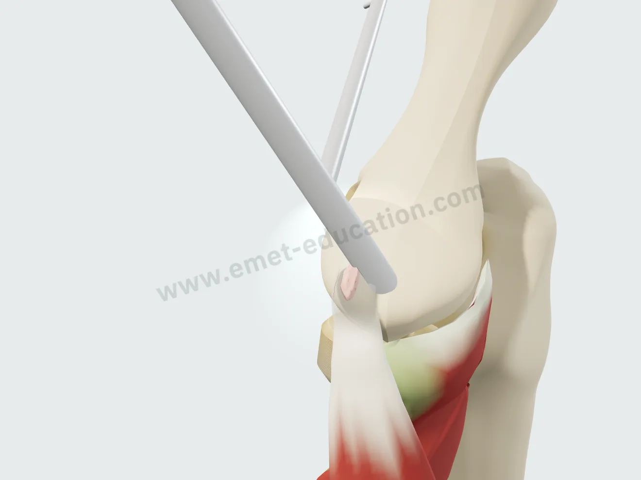 Arthroscopie : la face profonde du tendon, abîmée, a été retirée ; la couche superficielle est conservée.