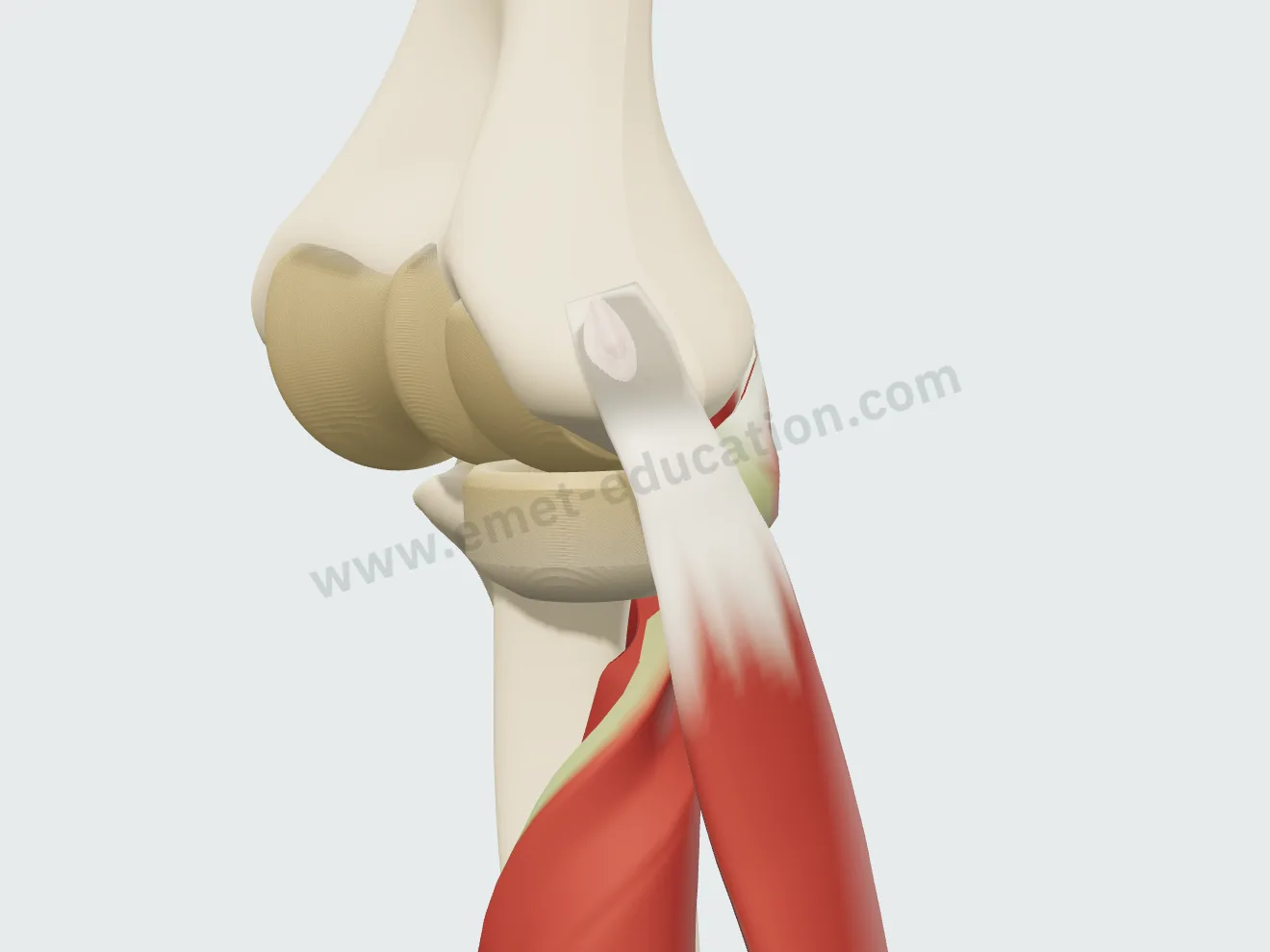 Un an après l'arthroscopie : le creux laissé dans la face profonde du tendon est comblé par une cicatrice lisse.