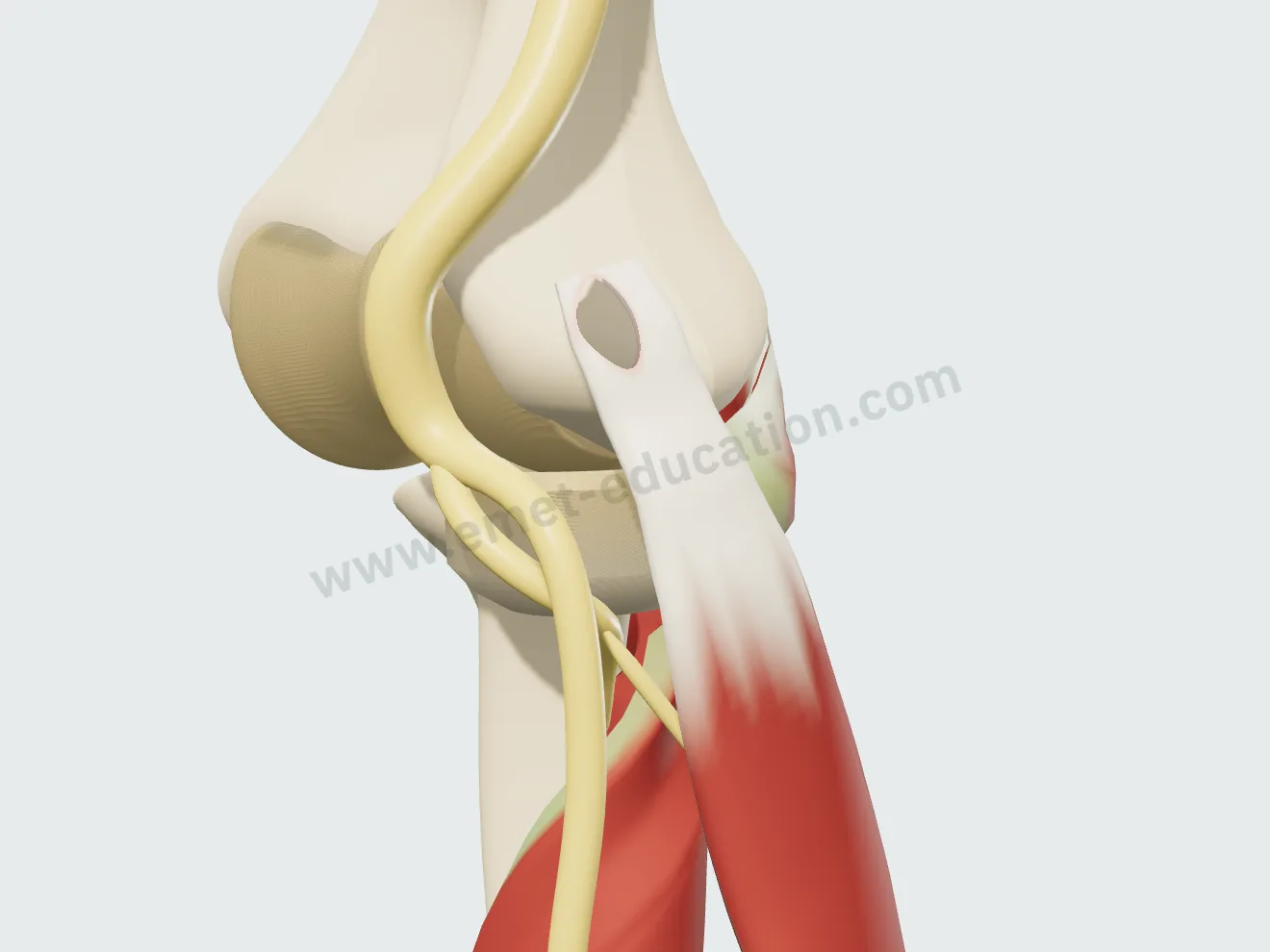 Chirurgie à ciel ouvert : le fragment de tendon abîmé a été retiré, laissant une fenêtre sur l'épicondyle, entourée de tendon sain.