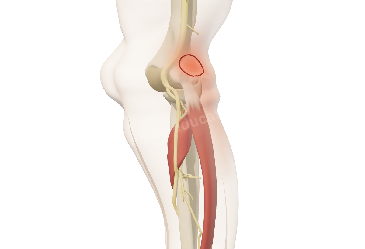 Modèle 3D du coude vu de dehors, la peau en transparence : la zone douloureuse du tennis elbow, sur l'épicondyle latéral