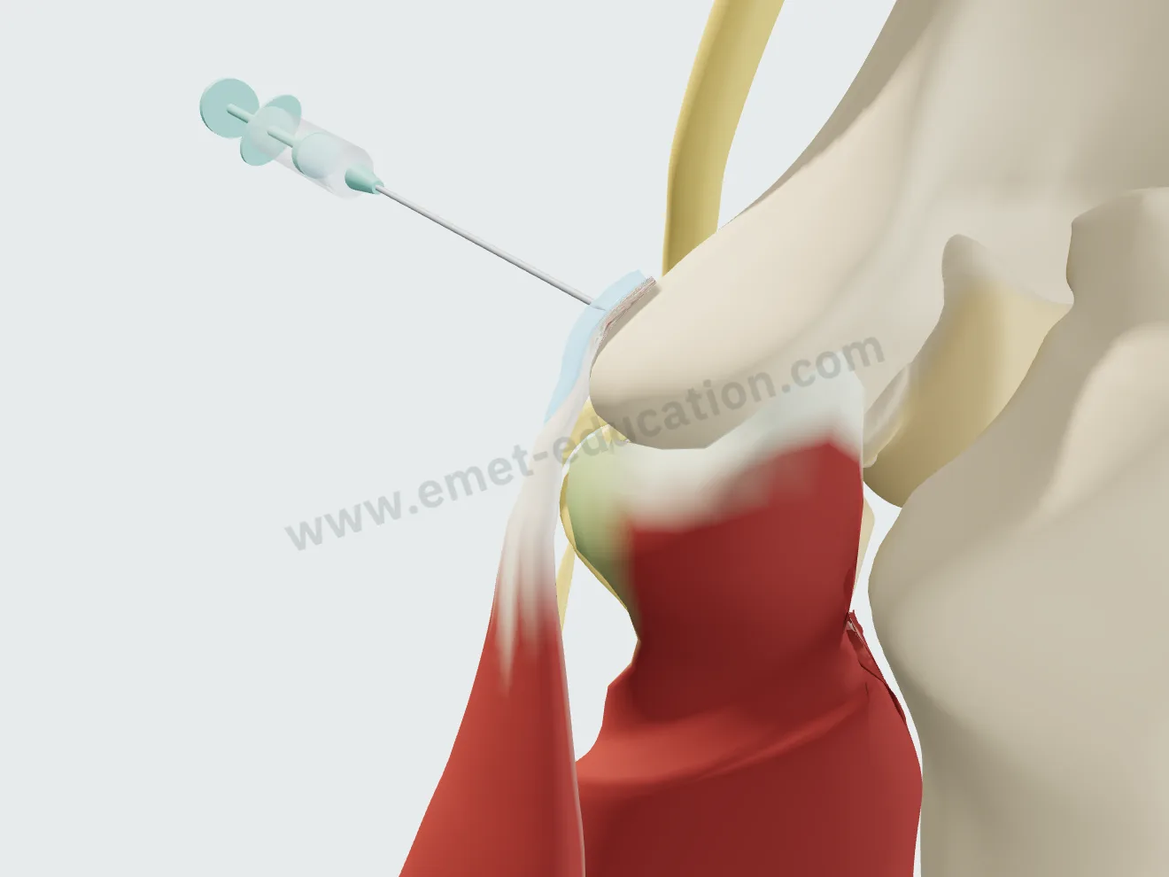 Infiltration : le produit, bleuté, s'étale à la surface du tendon autour de son attache.