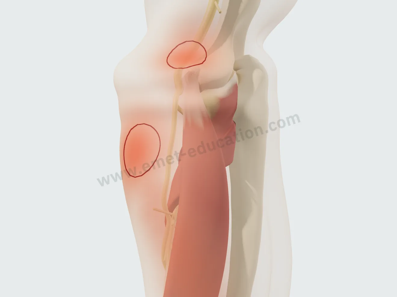 La peau du coude en transparence : deux zones douloureuses, l'une sur l'épicondyle pour le tendon, l'autre quelques centimètres plus bas pour le nerf.