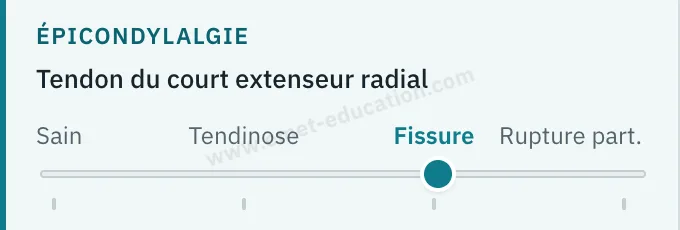 Panneau du modèle : jauge du tendon du court extenseur radial, au cran « Fissure ».