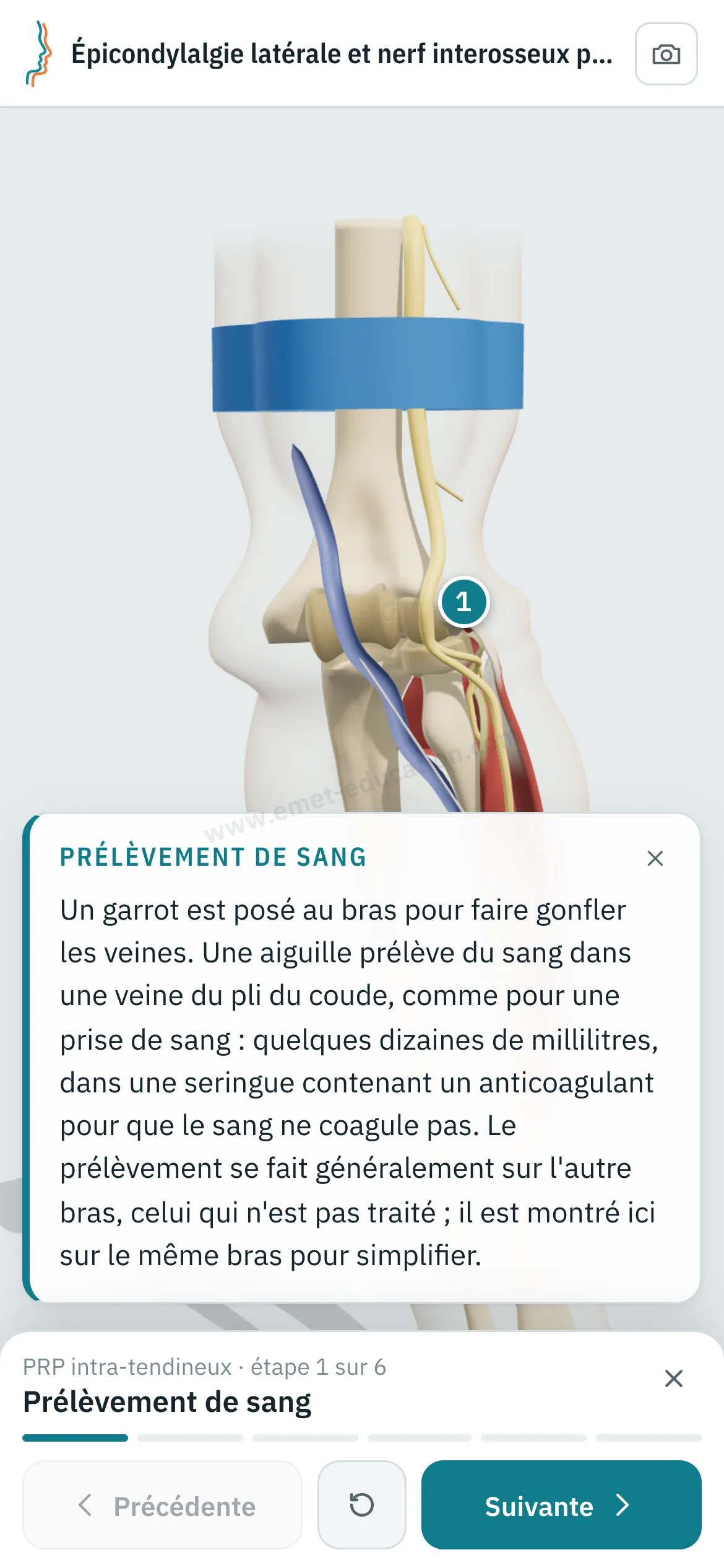 Vue patient sur un téléphone : le PRP intra-tendineux rejoué étape par étape.