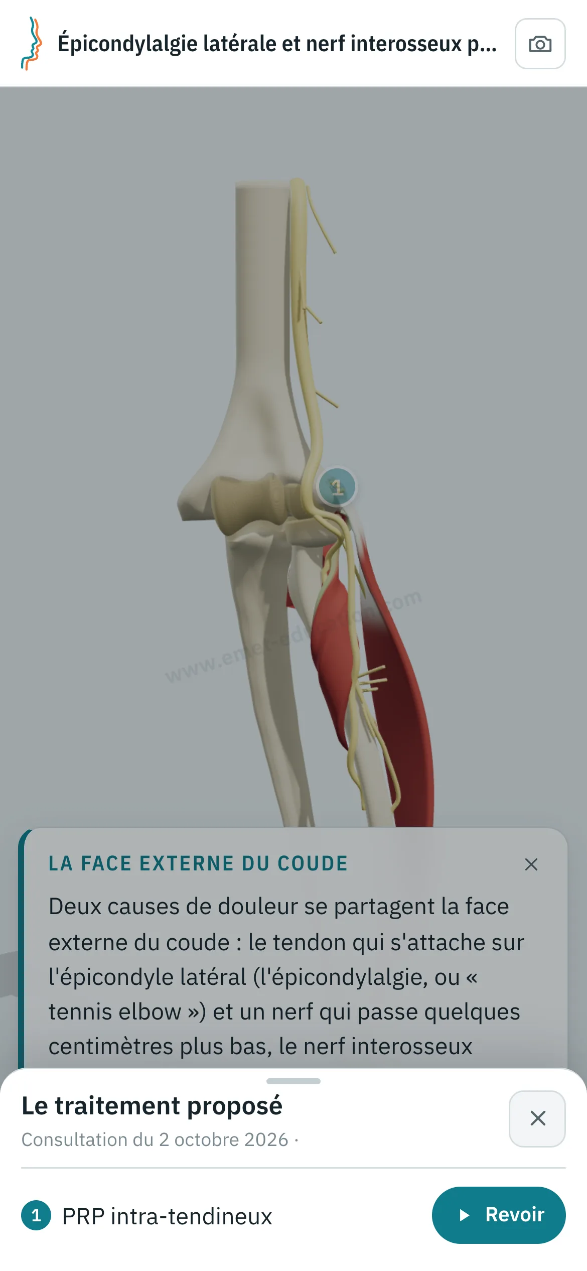 Vue patient sur un téléphone : le coude après PRP intra-tendineux, et le volet « Le traitement proposé » ouvert, avec le bouton « Revoir ».