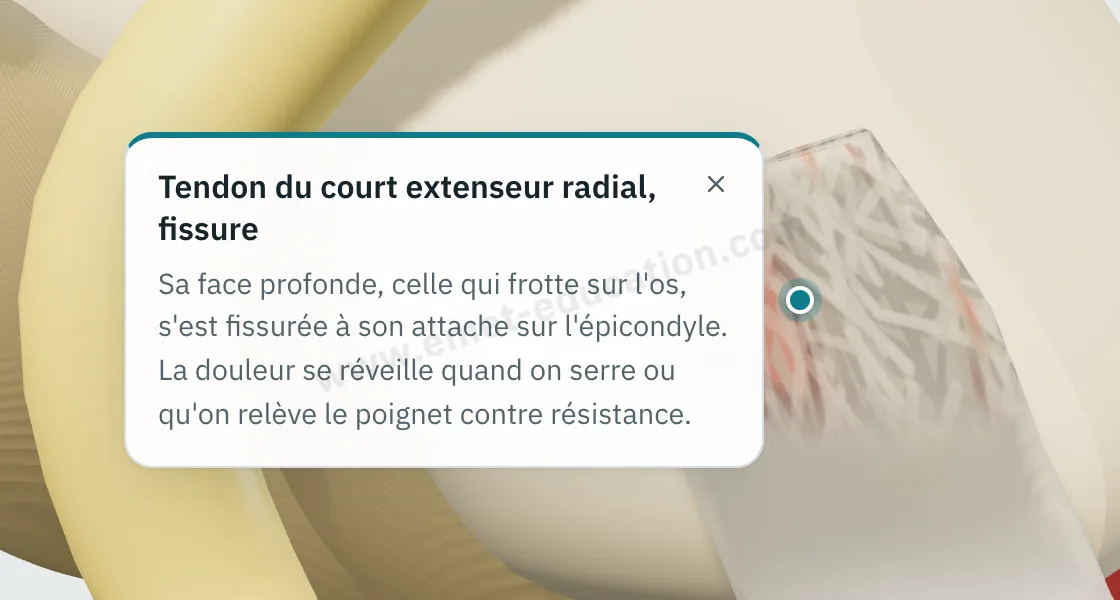 Bulle d'explication « Tendon du court extenseur radial, fissure » affichée après un toucher sur le tendon du court extenseur radial.