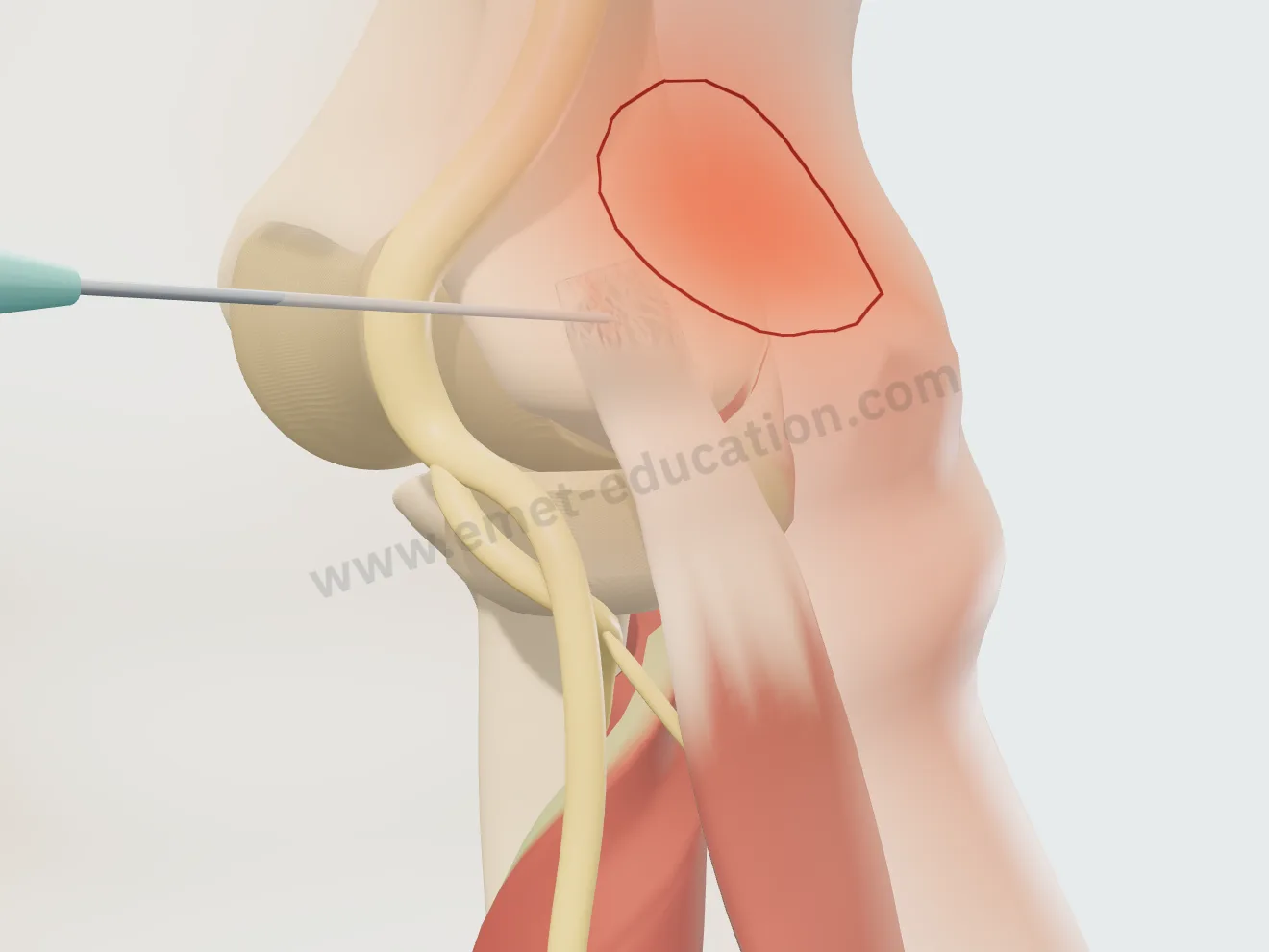PRP, étape 4 : l'aiguille dans l'enthèse du court extenseur radial, à mi-épaisseur, au travers du tendon translucide.