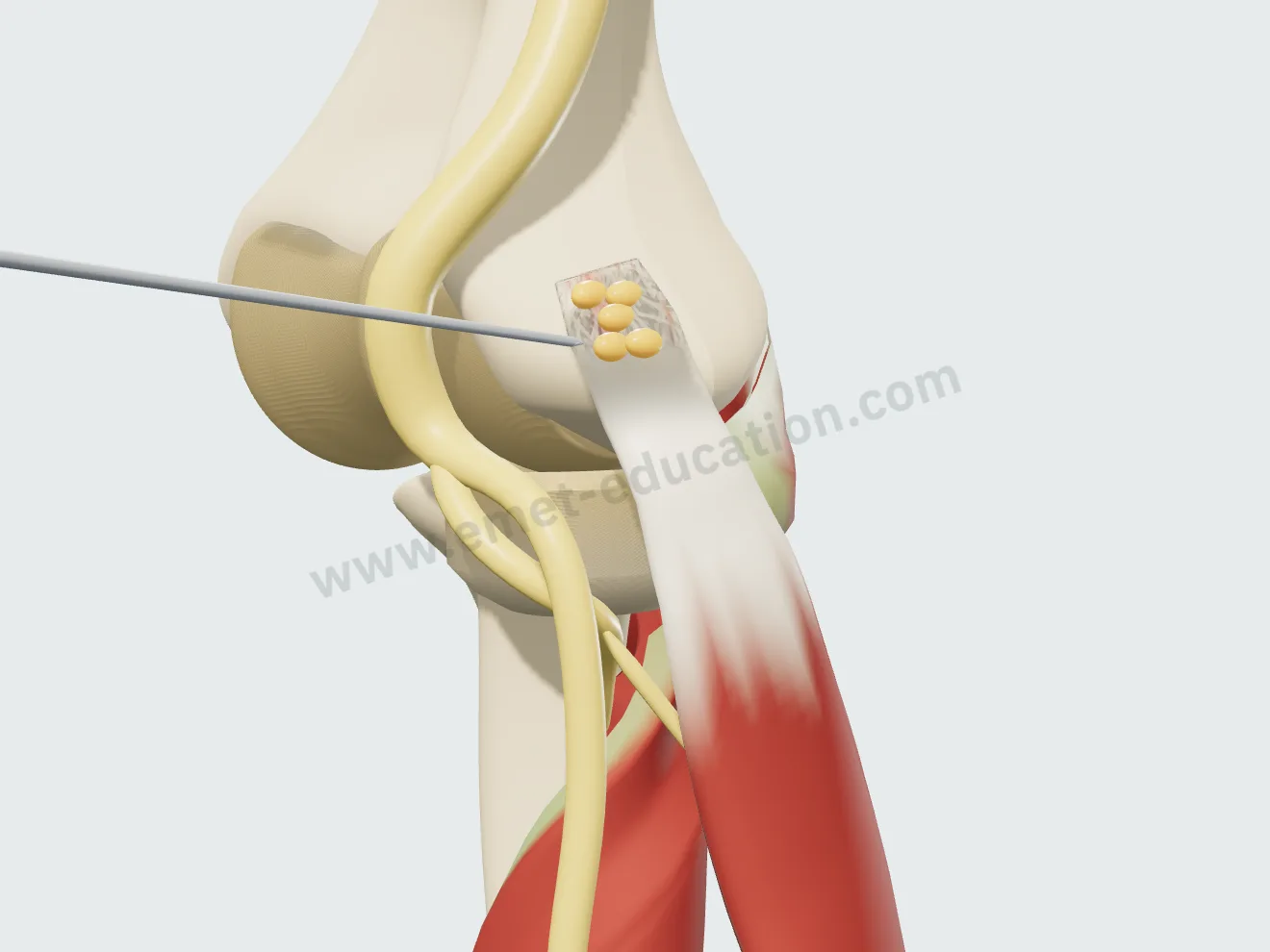 Injection du PRP : l'aiguille dépose le PRP en plusieurs points de l'attache du tendon.