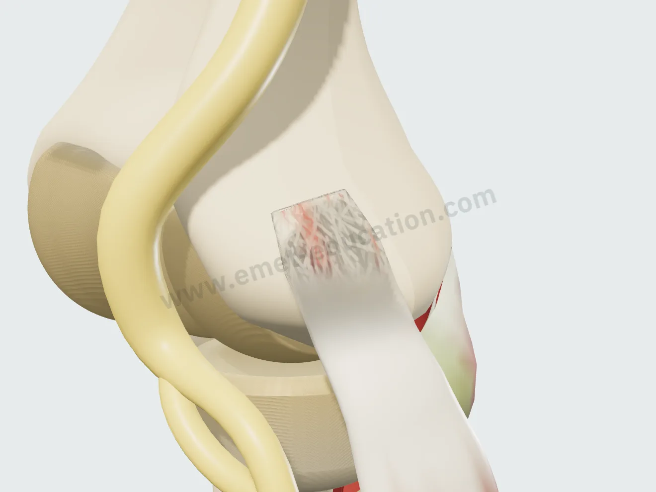Fissure : un sillon rouge sombre creuse la face profonde du tendon, vu au travers du tendon rendu transparent.